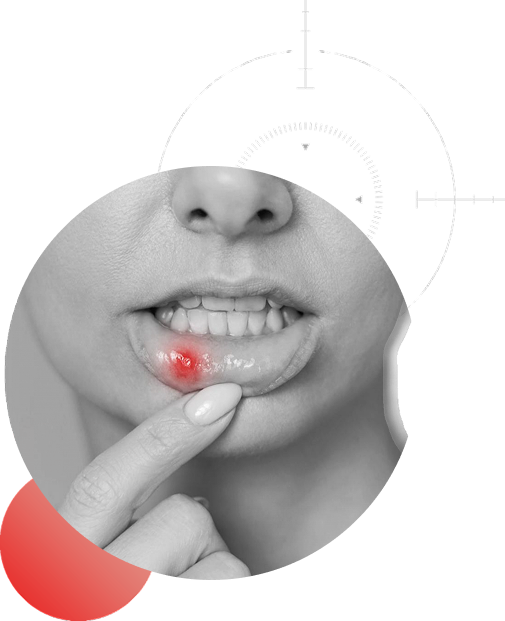 Närbild på mun med smärtsamt munsår - typiskt symptom på afte som går att behandla med Oralmedic